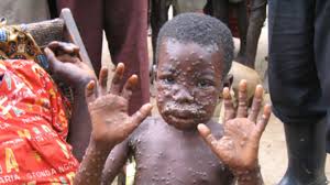 Lagos Records Two Cases Of Monkey Pox